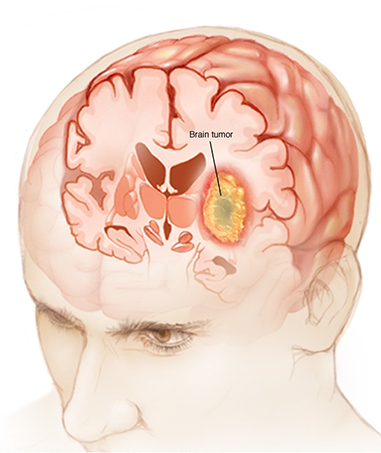 Brain Tumor