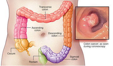 Colon Cancer