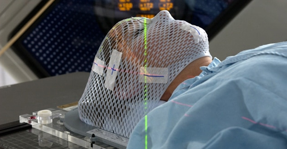 Stereotactic Radiosurgery