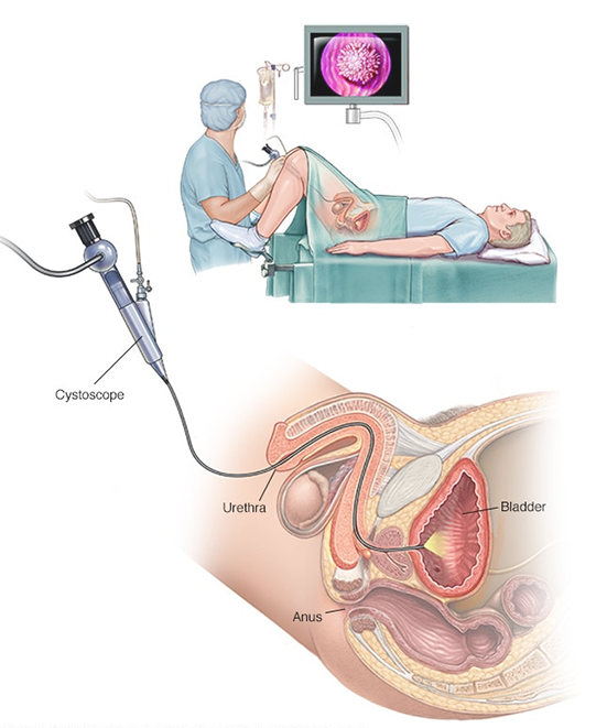 Treating Bladder Cancer