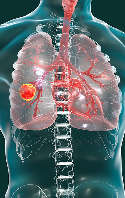 Lung Cancer